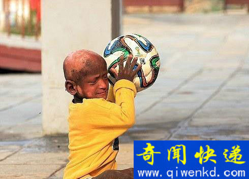 尼泊尔11岁的小男孩患罕见怪病