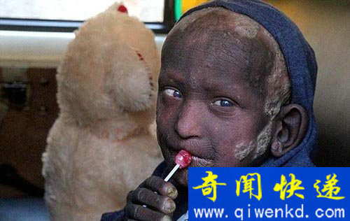 尼泊尔11岁的小男孩患罕见怪病