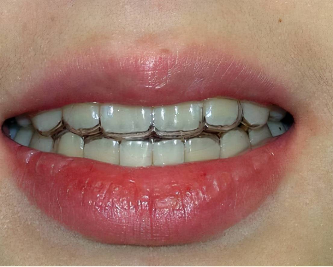 牙套价格一般是多少钱一个