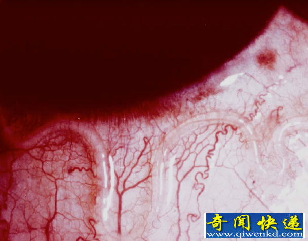 世界上最恐怖的寄生虫