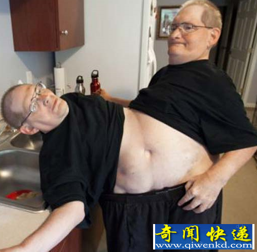 世界最老的连体人