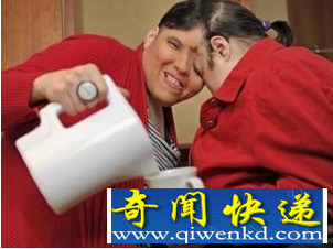 世界上最大的连体婴儿