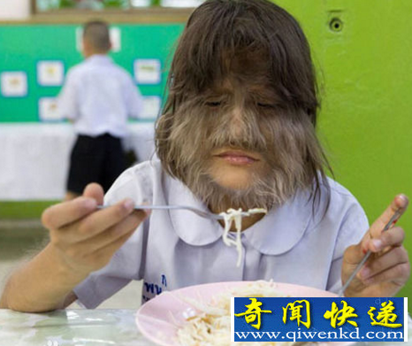 世界上毛发最多的女孩