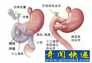 胰十二指肠切除术示意图
