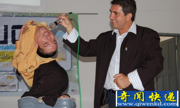 世界最恐怖的怪病