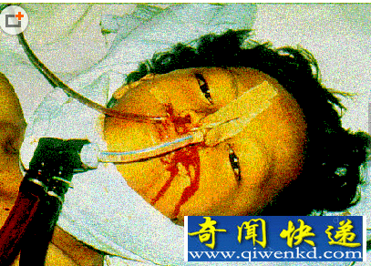 埃博拉病毒死者照片