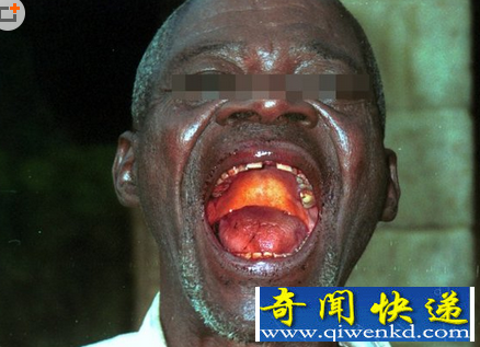 埃博拉病毒死者照片