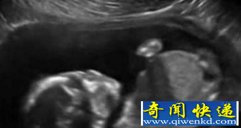 子宫内胎儿自打脸
