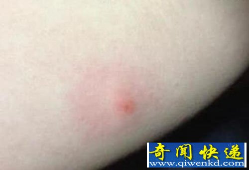 再也不能小看它了 女子被跳蚤咬后患重病截四肢