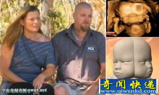 盘点世界各地让人心惊肉跳的怪胎 夫妇怀"双脸娃"