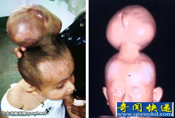 盘点世界各地让人心惊肉跳的怪胎 夫妇怀"双脸娃"