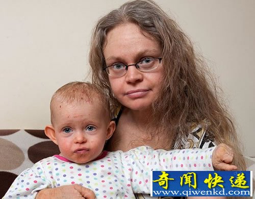 皮肤如纸般的脆弱 缺少蛋白质脱皮量是正常人的14倍