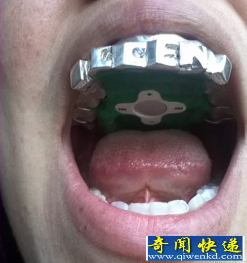 Play-A-Grill牙箍MP3 听音乐 无需耳机