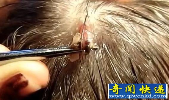 可怕!美国男子旅游归来头部留洞 罪魁祸首竟是马蝇