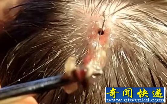 可怕!美国男子旅游归来头部留洞 罪魁祸首竟是马蝇