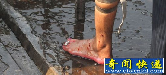 残忍且血腥:印度奇怪的“放血”疗法