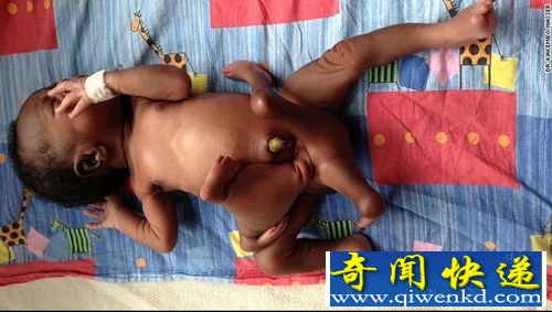 乌干达女子诞下罕见“双胞胎寄生胎” 长有4手4脚