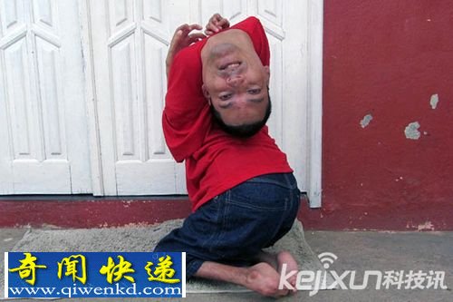 巴西男子脑袋长反 异常聪明逆转人生
