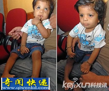 印一男孩有14个手指和20个脚趾 称之为“多指畸形”