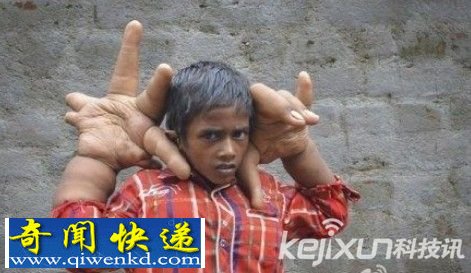 印度8岁男孩患怪病 一双巨手比头部更大医生对此也束手无策