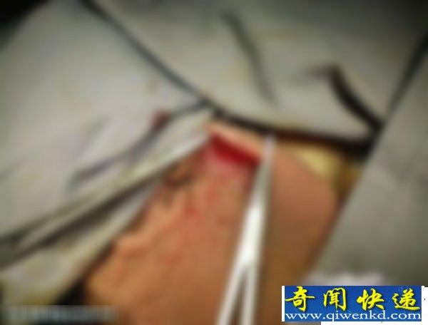 实拍揭秘男性结扎绝育手术全过程(有图慎入)