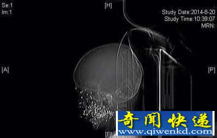 ������ͯ����ȼ���ڷ�������ǹ 86�Ÿ���ը��ͷ��