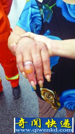 常州老太铝环当成戒指戴 手指险些勒坏死