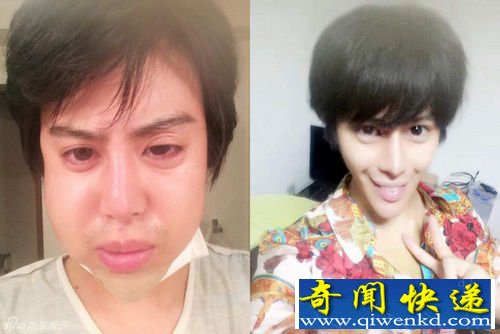 日本整形艺人Allen锥子脸夸张 被指似漫画人物