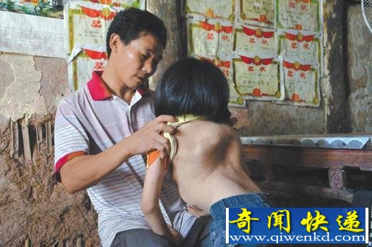 达州“漏斗女孩”因患疾病,可能面临辍学