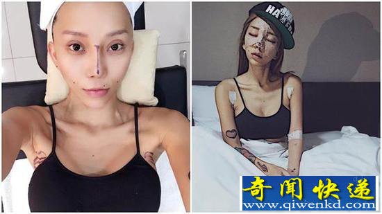 女模林云自曝十年整容史 亲身尝试最新整形技术