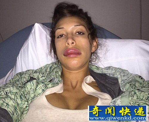 女星弗拉·亚伯拉丰唇手术失败上嘴唇增厚像"鸭子"