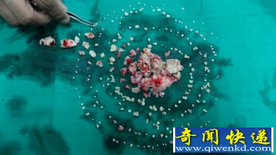 奇葩!印度少年嘴中取出232颗牙【图】
