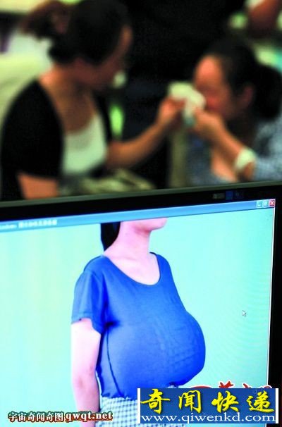 13岁女学生发育异常乳房大如篮球重量是常人20倍