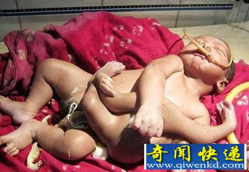 印度男婴被奉为神灵 长有四手四脚