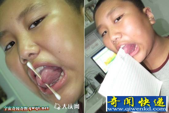 大庆一13岁男孩舌头分叉能夹物