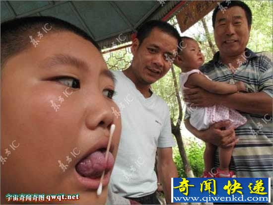 大庆一13岁男孩舌头分叉能夹物