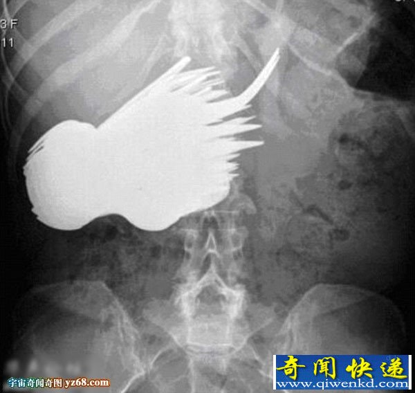荷兰女子胃疼难忍 医生从其肚子里取出78把餐具