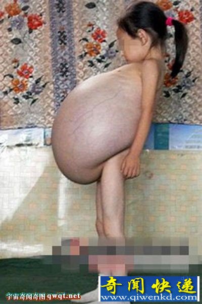女童患怪病肚子大过孕妇 跑遍当地医院无果