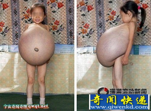 女童患怪病肚子大过孕妇 跑遍当地医院无果
