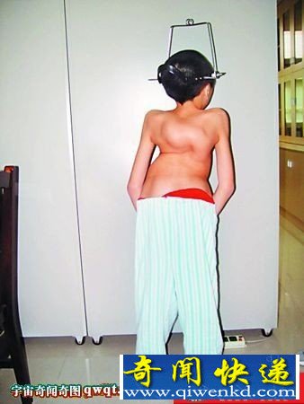 小琴的脊柱几乎扭成麻花。 贵州14岁女孩脊柱弯着长成麻花状生命垂危