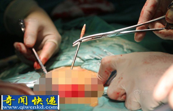 湖南衡阳:男子为持久兴奋钢钉插尿道致钢钉滞留