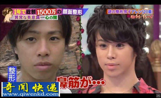 日男整形肿成猪头 整完被调侃“真蛇精”