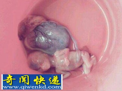 血腥，慎入! 实拍堕胎取出小生命的全过程