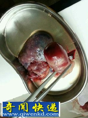 血腥，慎入! 实拍堕胎取出小生命的全过程