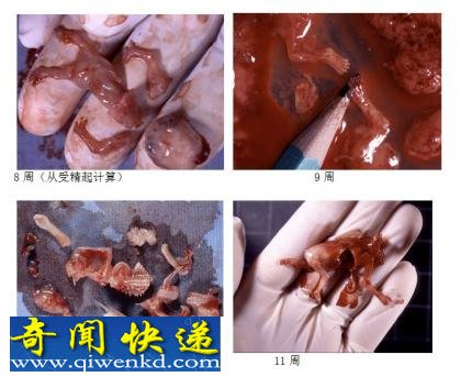 血腥，慎入! 实拍堕胎取出小生命的全过程