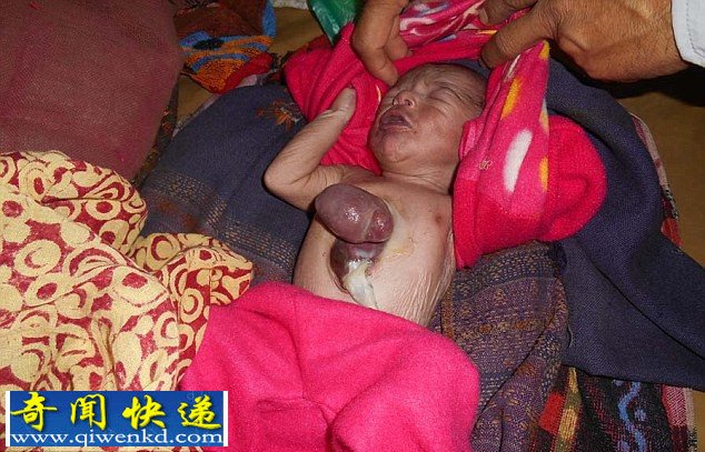 印度一新生儿心脏异位已奇迹存活6天 在当地接受治疗