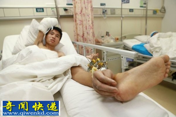 荒谬!奇葩医生将男子的断手移植到脚踝上