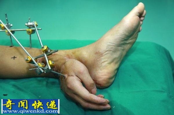 荒谬!奇葩医生将男子的断手移植到脚踝上