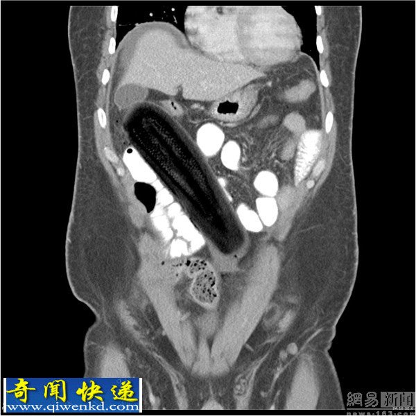 盘点世界各地奇葩X射线影像:假阳具进入人体
