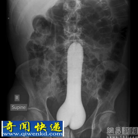盘点世界各地奇葩X射线影像:假阳具进入人体